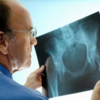 Инновационные методы лечения остеопороза в Израиле