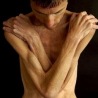 Лечение анорексии в Израиле: красота, которая не требует жертв